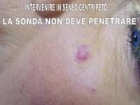 angioma capillare viso