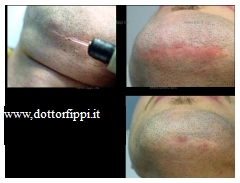 CicatriciCheloidi