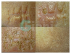 CicatriceSullaFronte