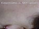 neoformazioni viso un anno dopo