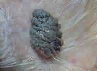 verruca seborroica