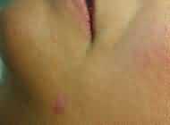 fibroma del viso dopo